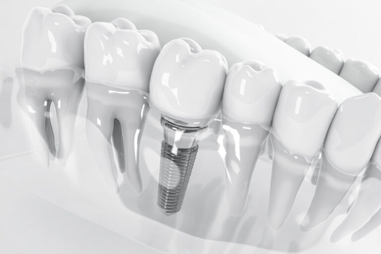 implanty zębów olsztyn