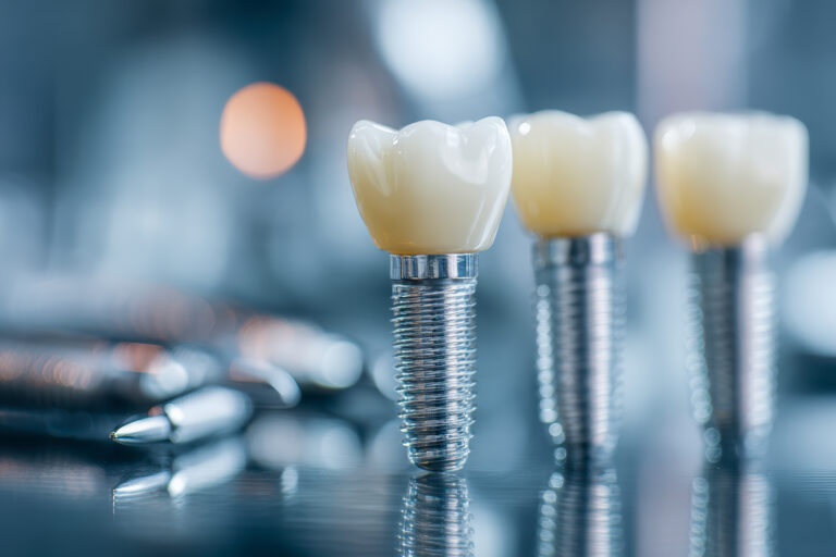 Zęby w jeden dzień – natychmiastowe obciążenie implantów